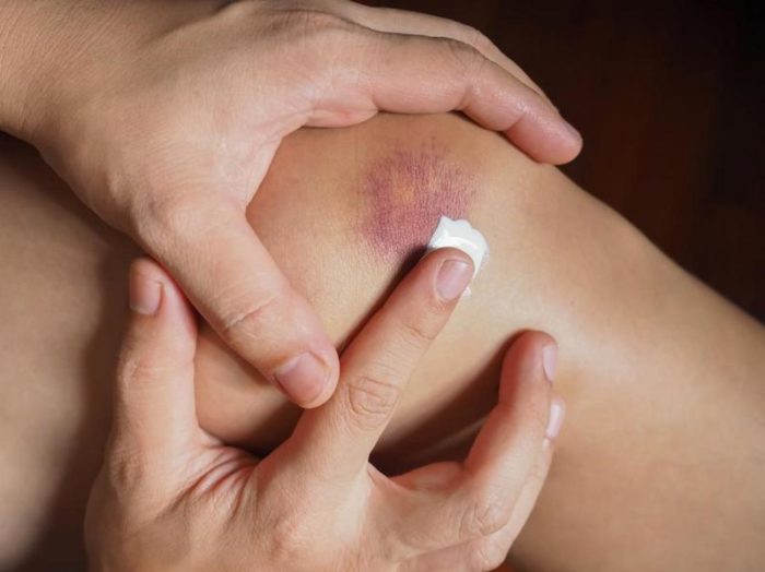 person-applying-cream-or-ointment-to-bruised-skin